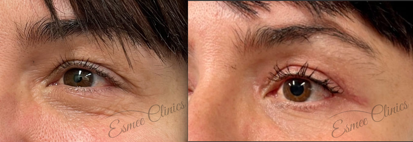 Before and After img